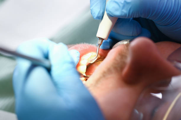 Best Emergency Gum Treatment in Riviera Beach, FL